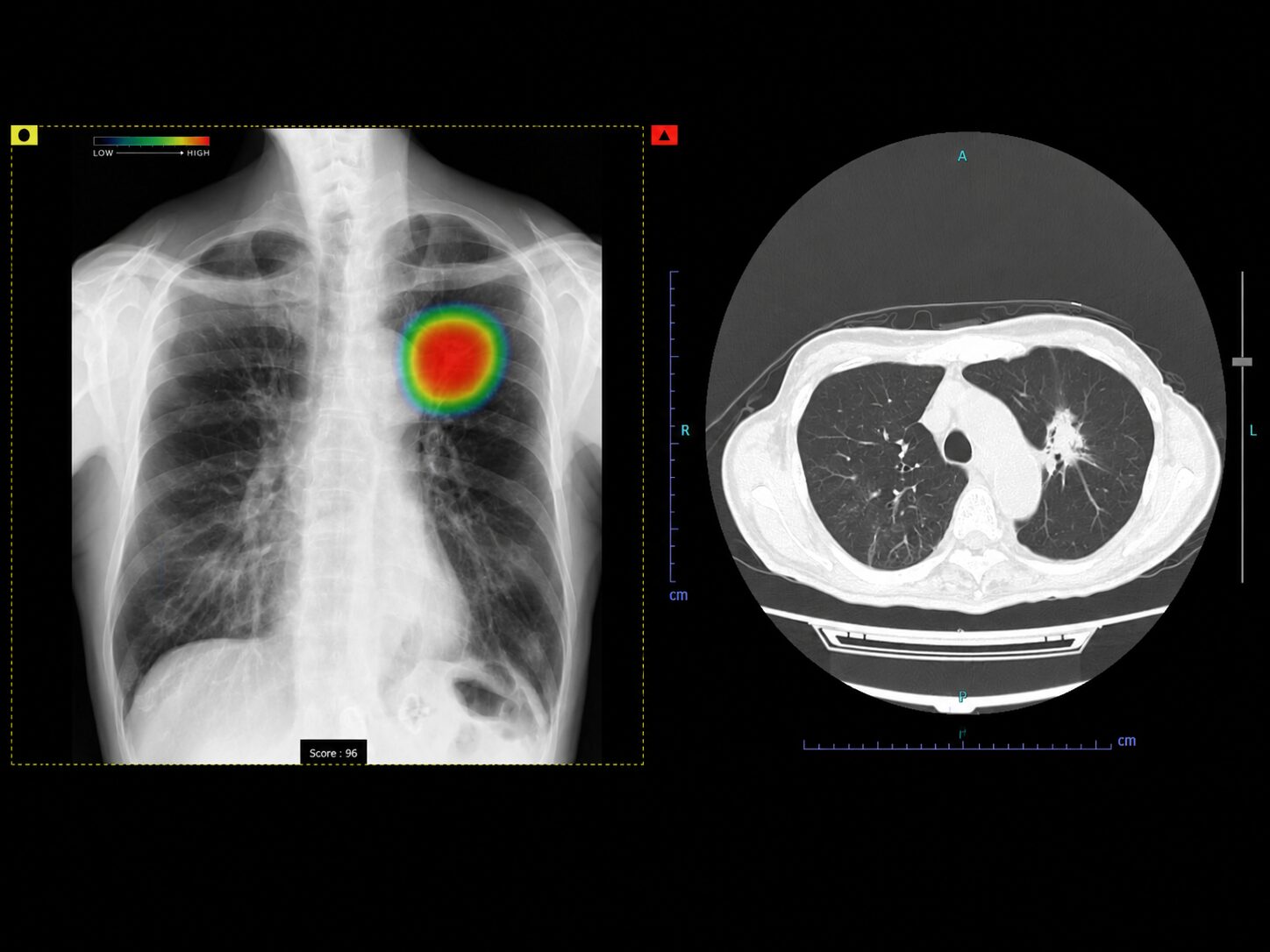 胸部単純X線画像診断支援システム「CXR-AID」